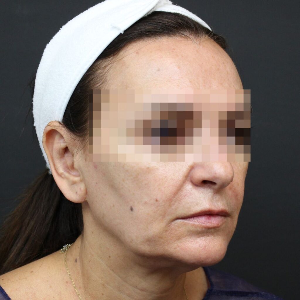 minilifting facial 7 antes