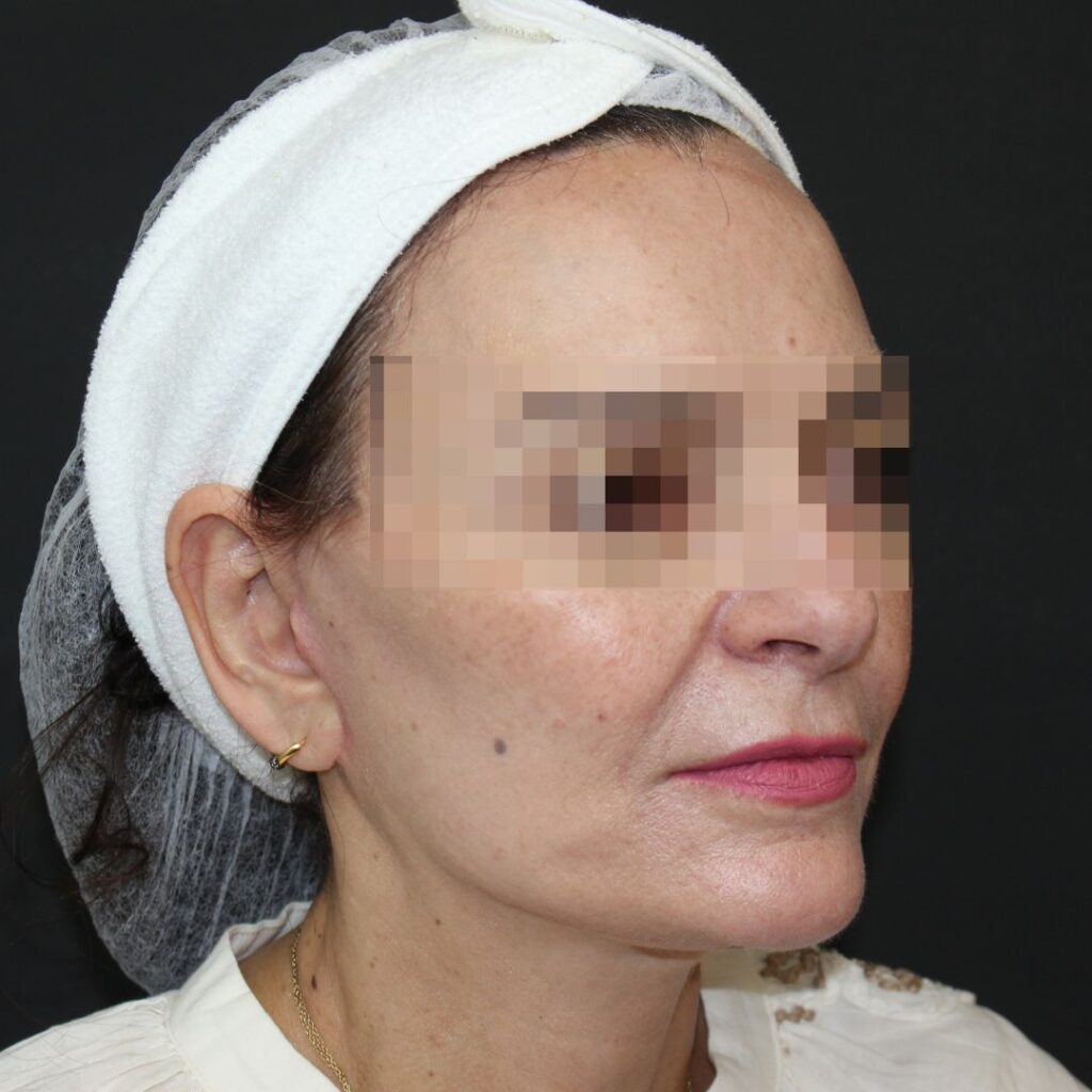 minilifting facial 7 despues