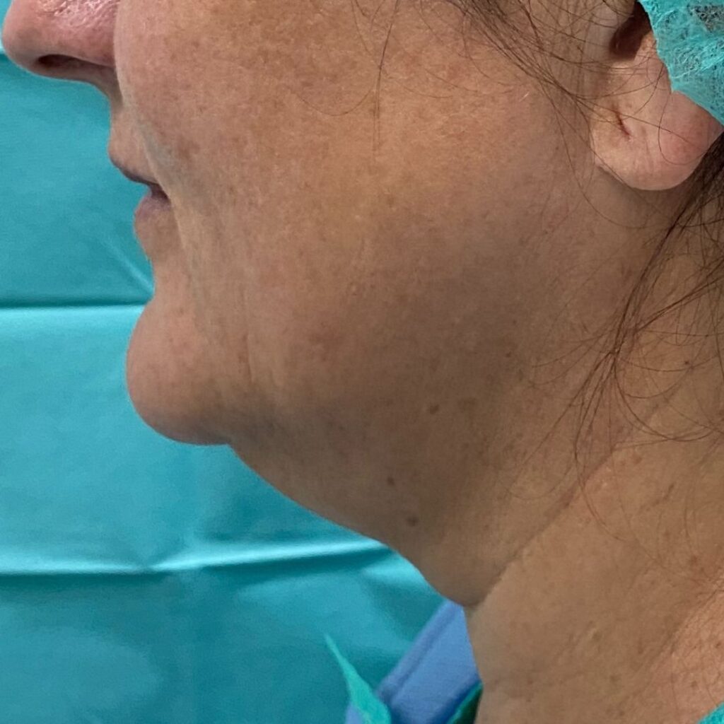 liposuccion de papada 2 antes