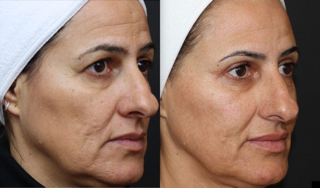 lipofilling-facial