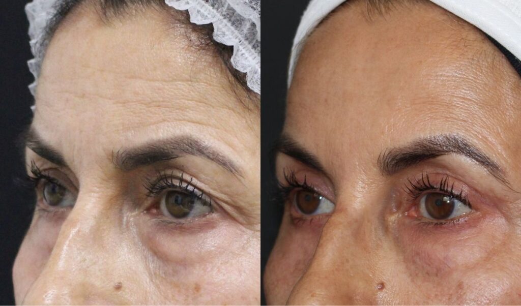 blefaroplastia-superior-sevilla