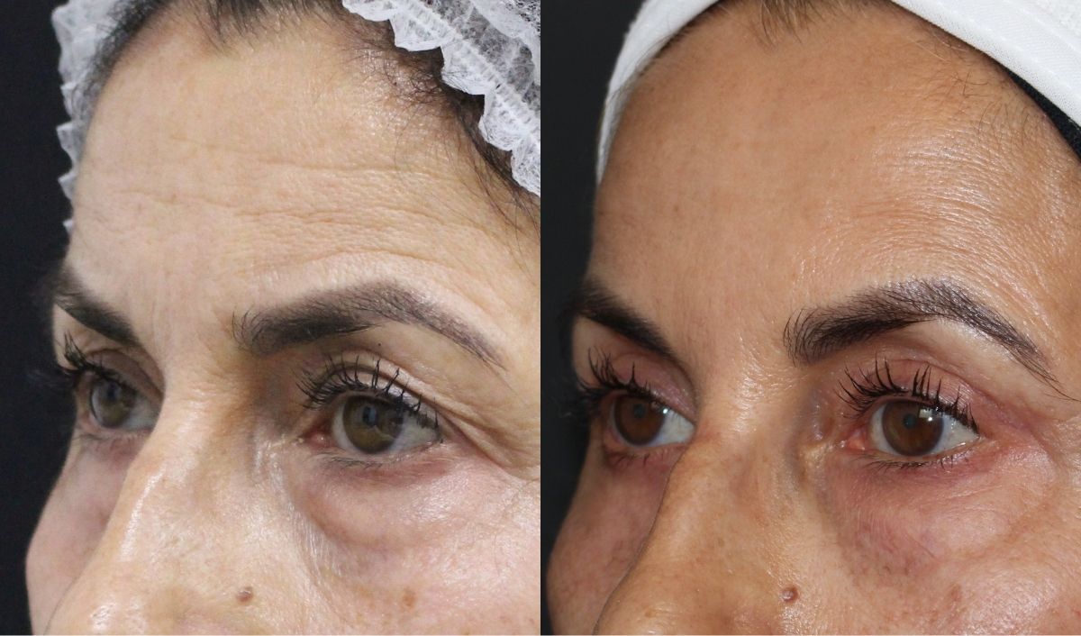 blefaroplastia-superior-sevilla