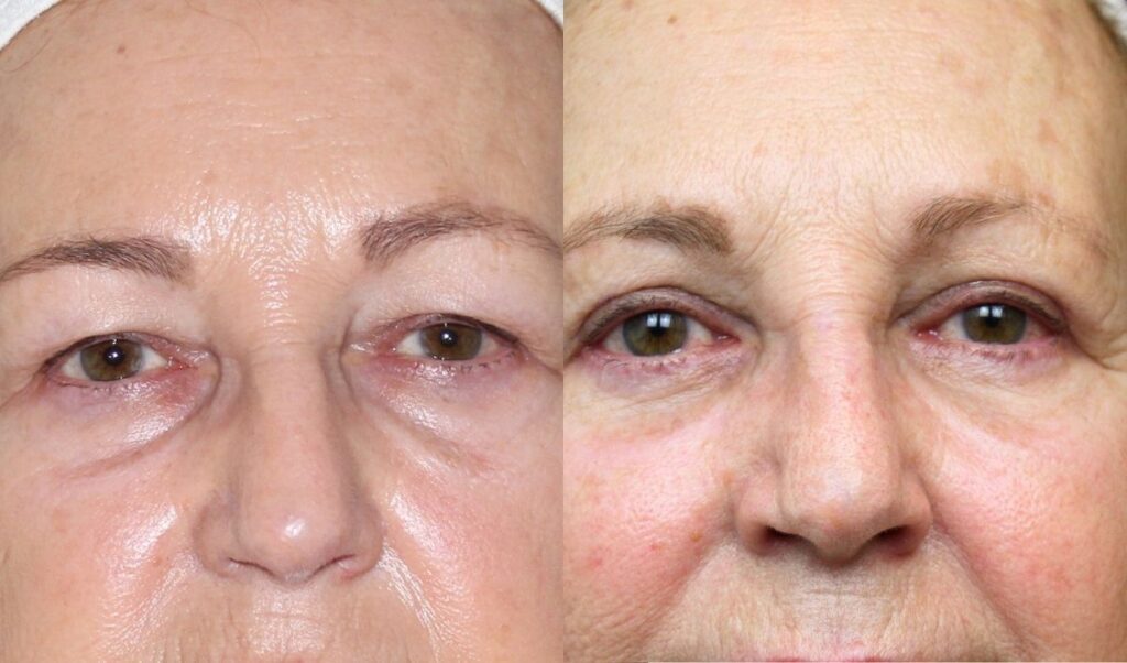 organizar-una-blefaroplastia