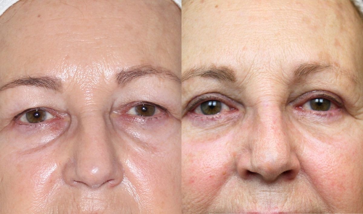 organizar-una-blefaroplastia