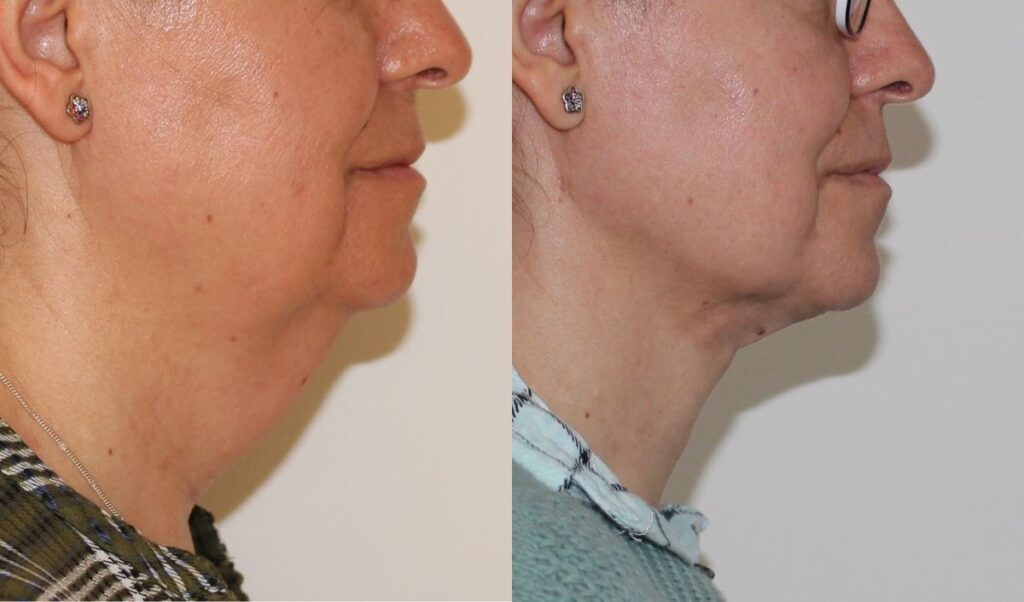 que-es-la-liposuccion-de-papada