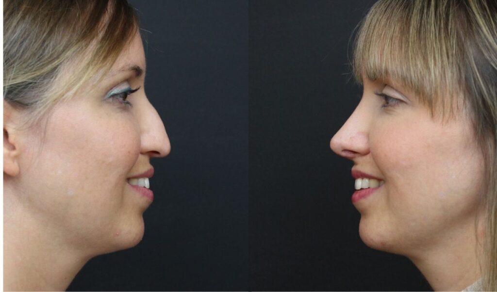 recuperacion-rinoplastia-ultrasonica