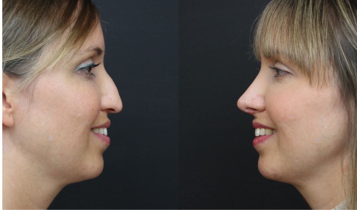 recuperacion-rinoplastia-ultrasonica