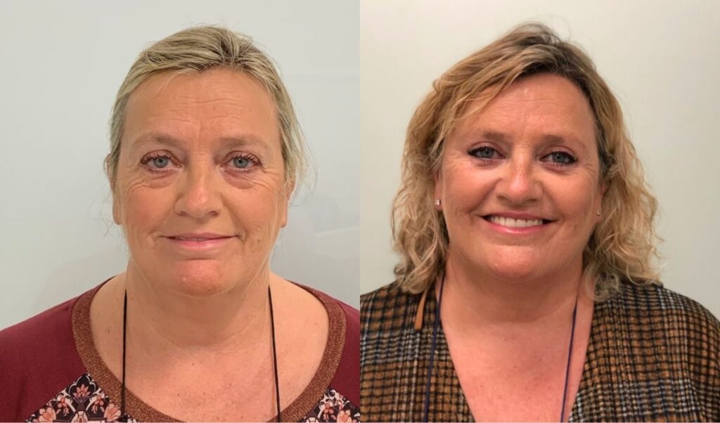 blefaroplastia-sevilla