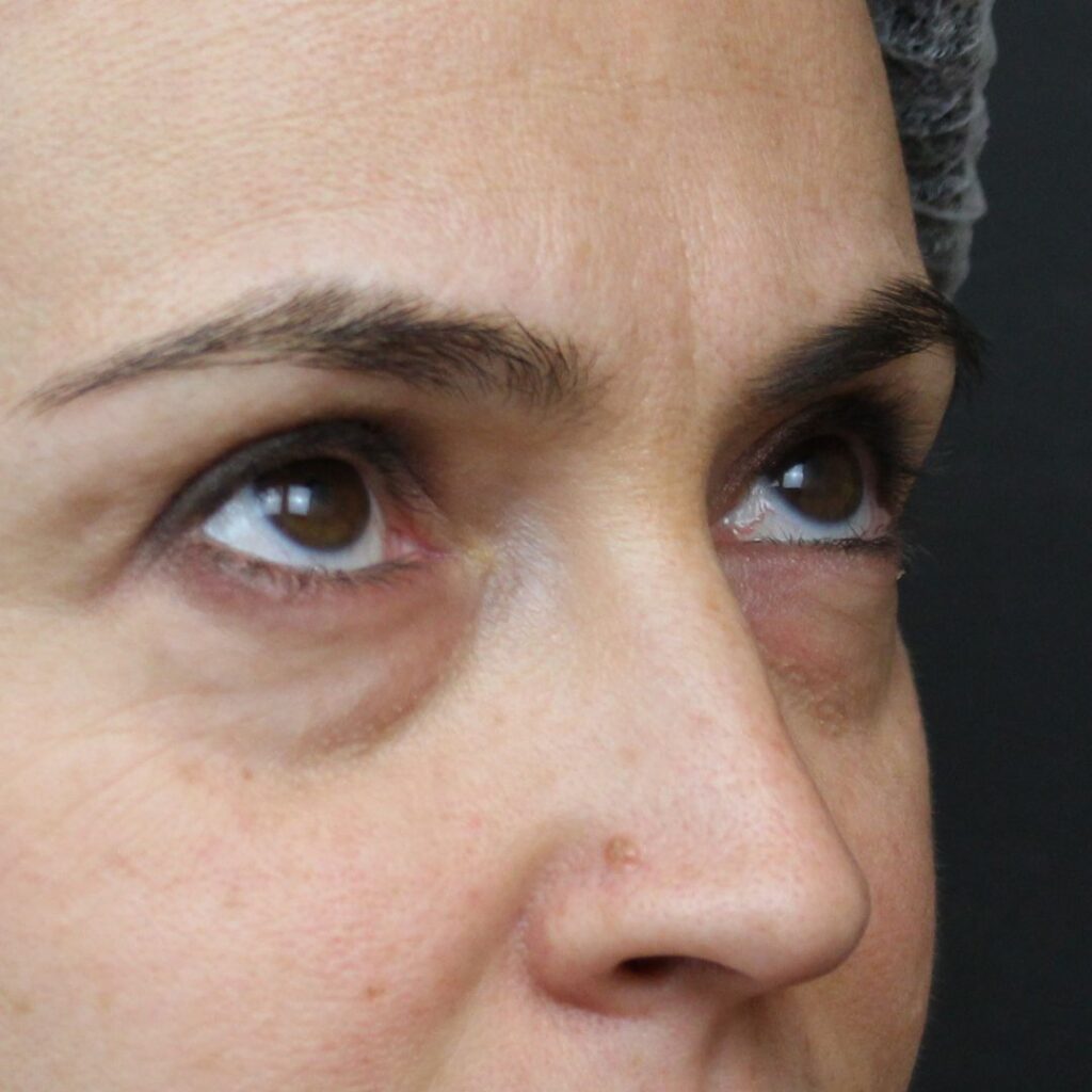 blefaroplastia-inferior