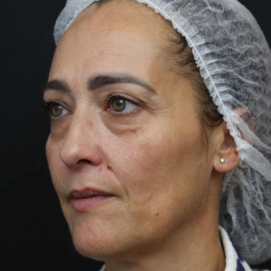 blefaroplastia-antes