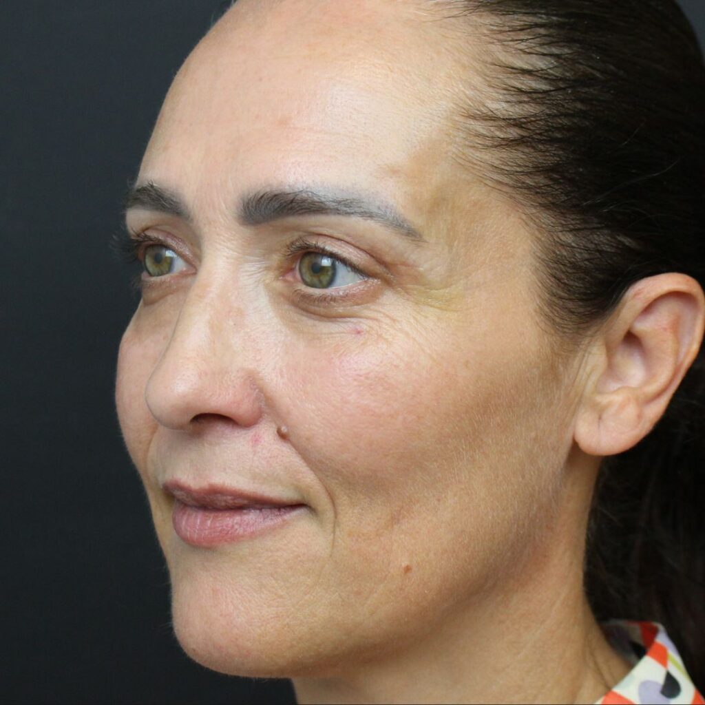 blefaroplastia-despues