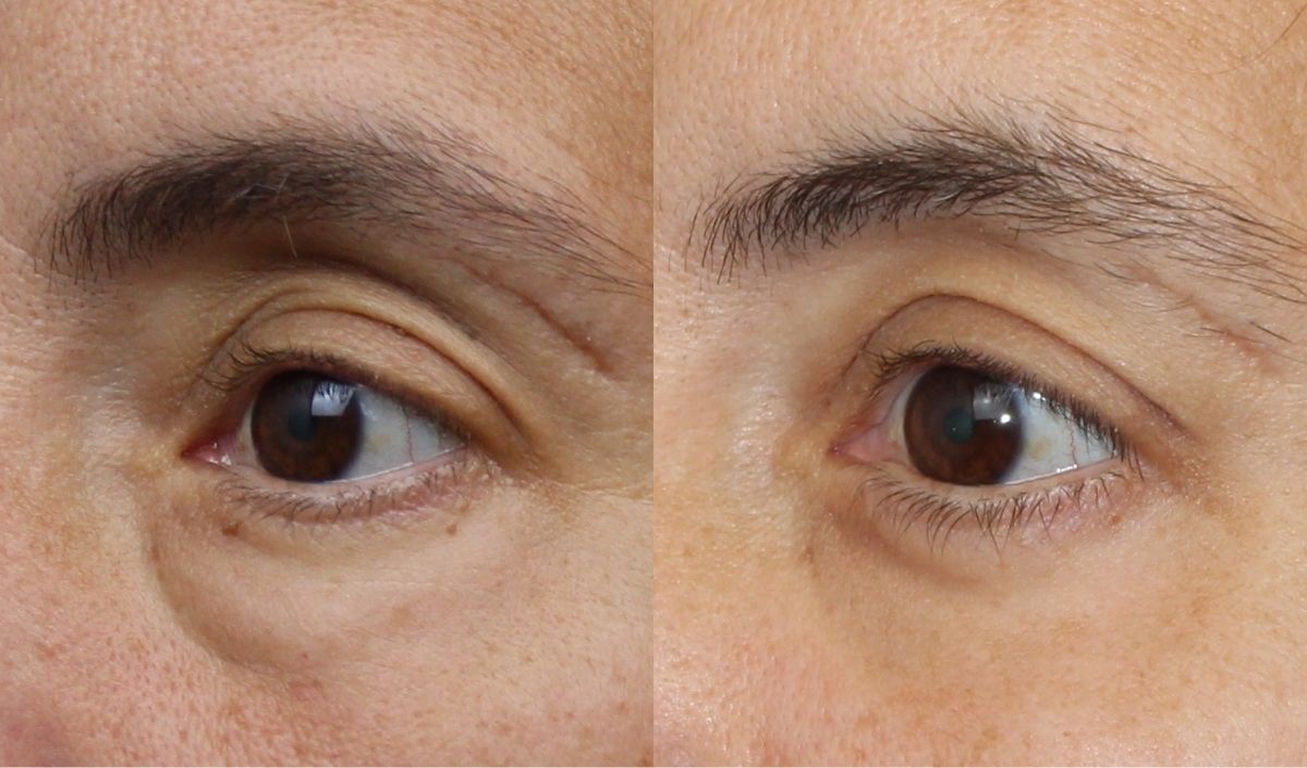 cicatrices-blefaroplastia
