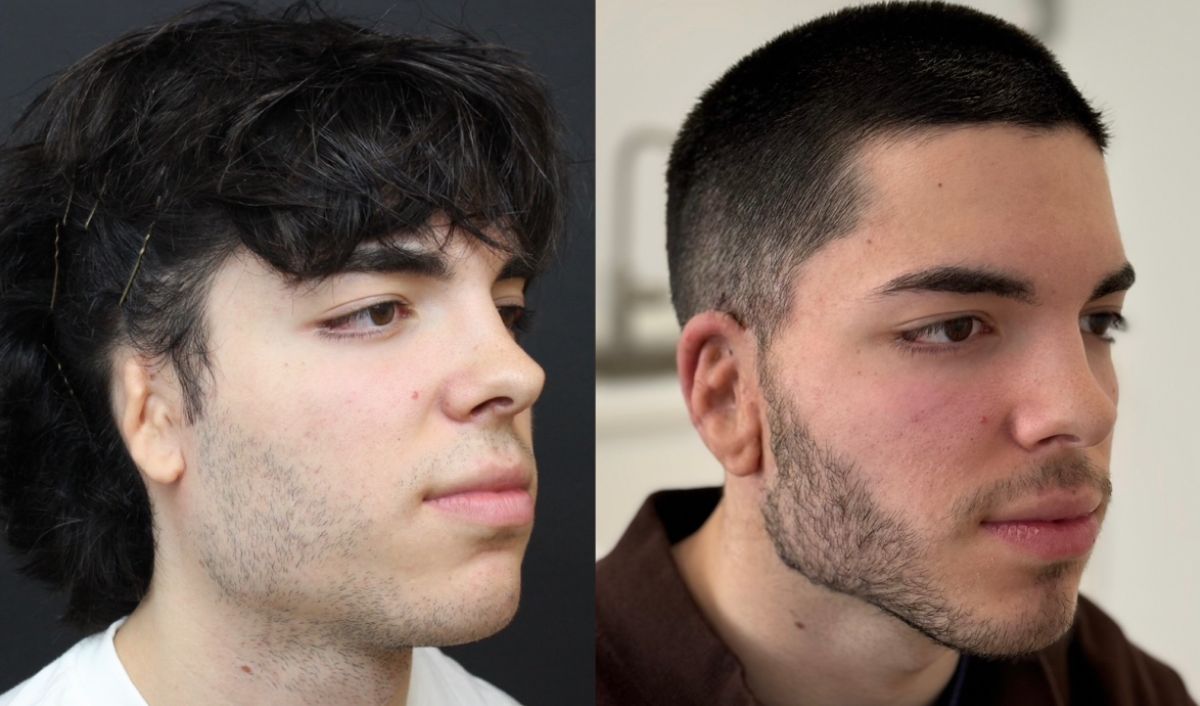 cirugia-reconstruccion-auricular