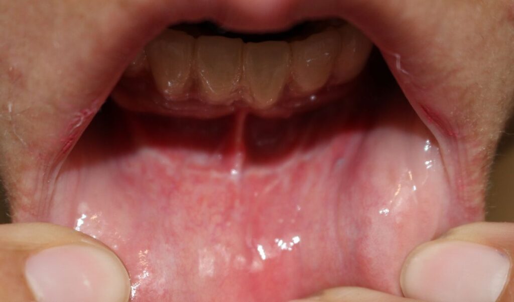 cicatriz-mentoplastia