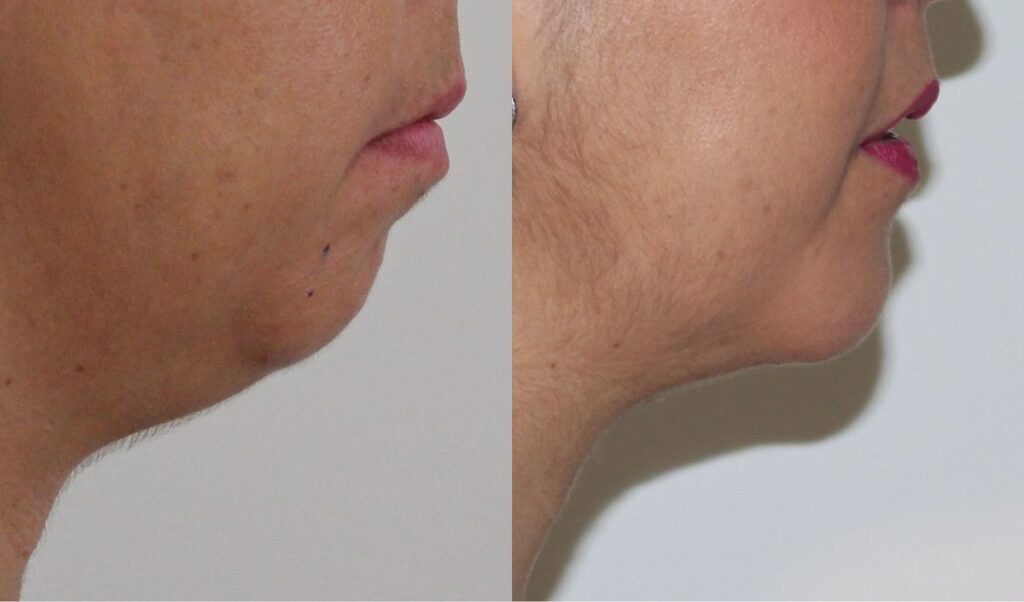 cuidados-mentoplastia