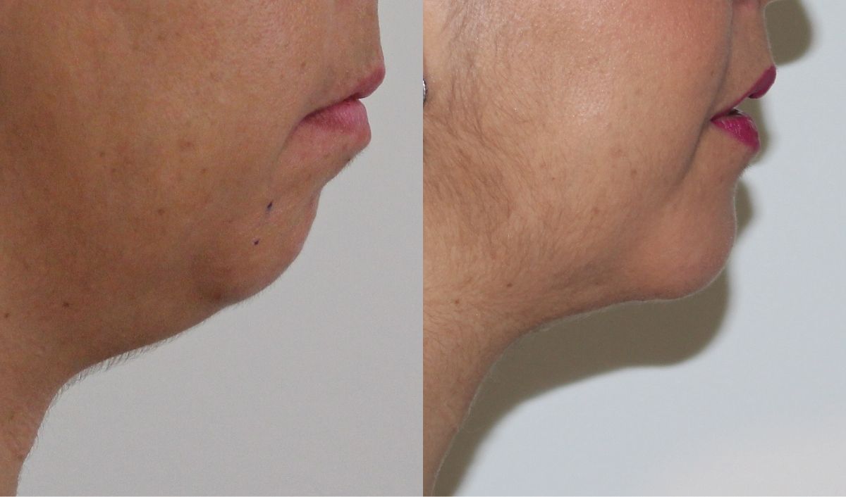 cuidados-mentoplastia