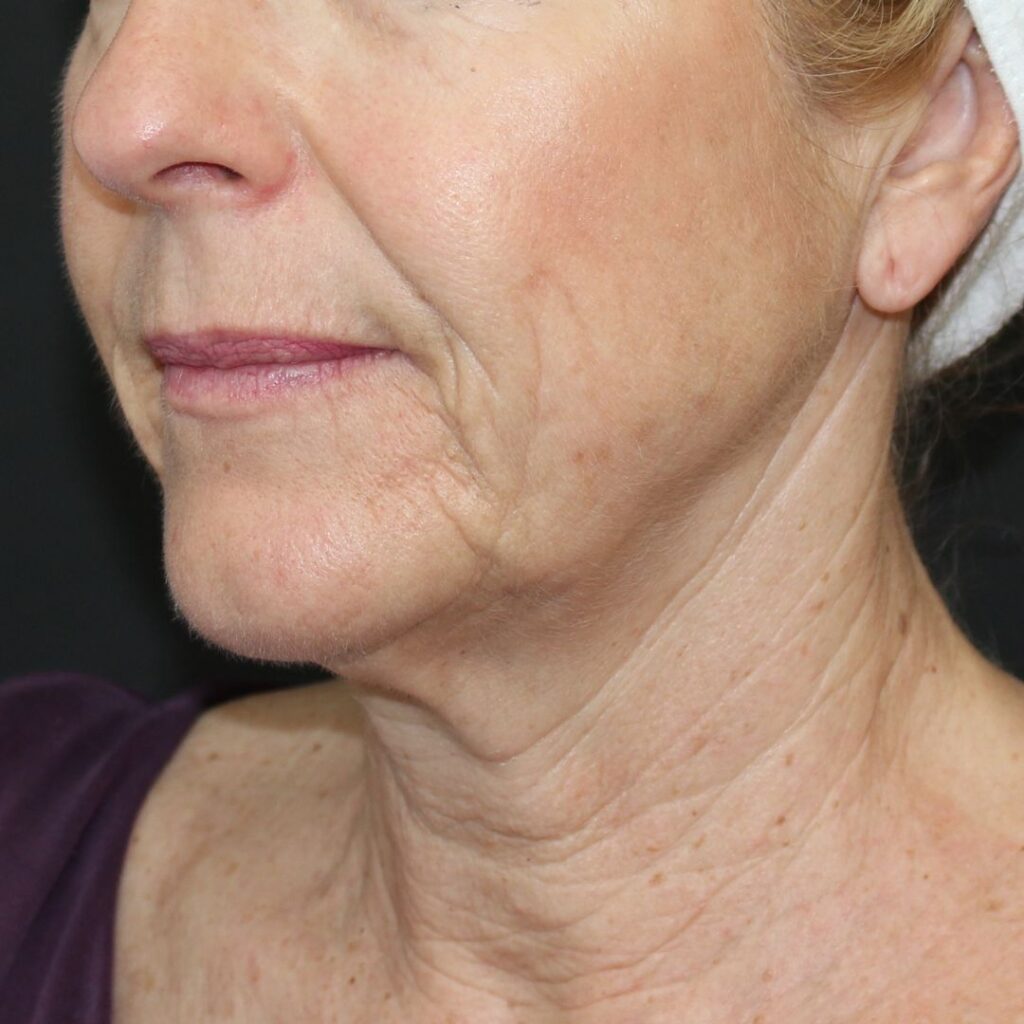 minilifting-cara-antes