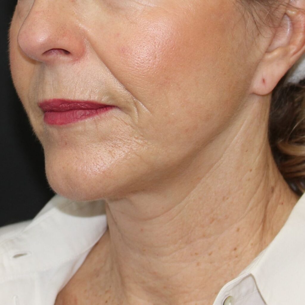 minilifting-cara-despues