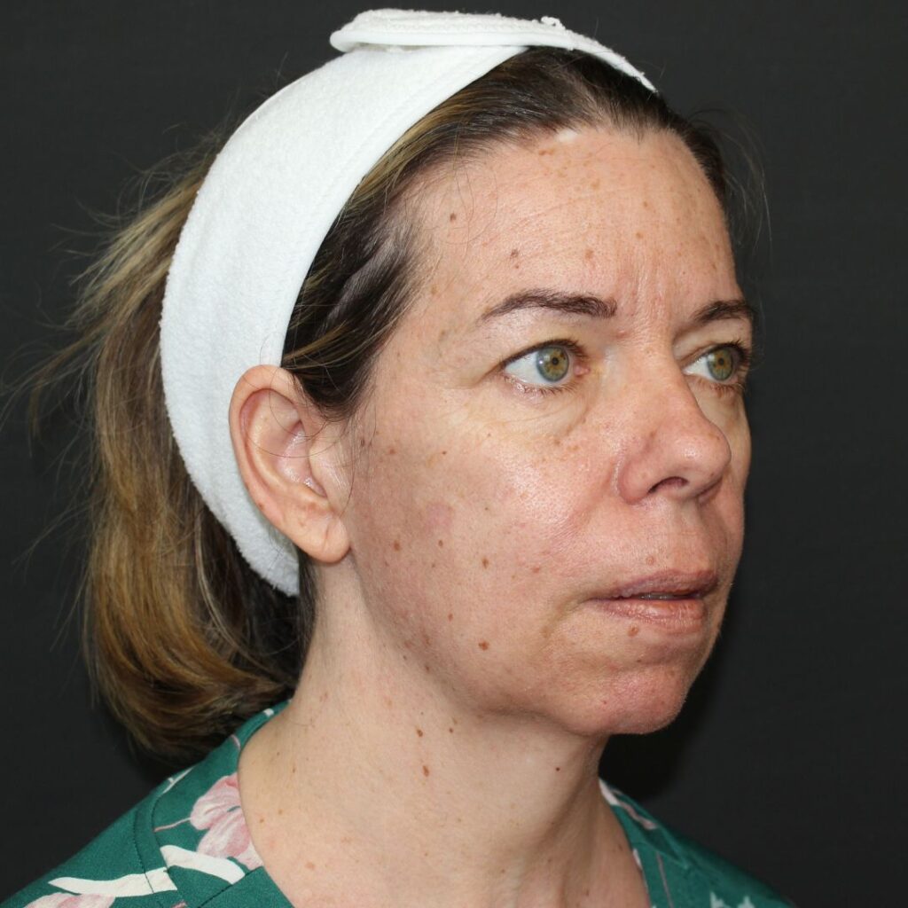 minilifting-mentoplastia-blefaroplastia