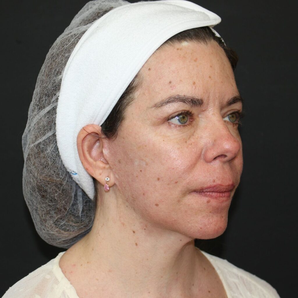 minilifting-mentoplastia-blefaroplastia