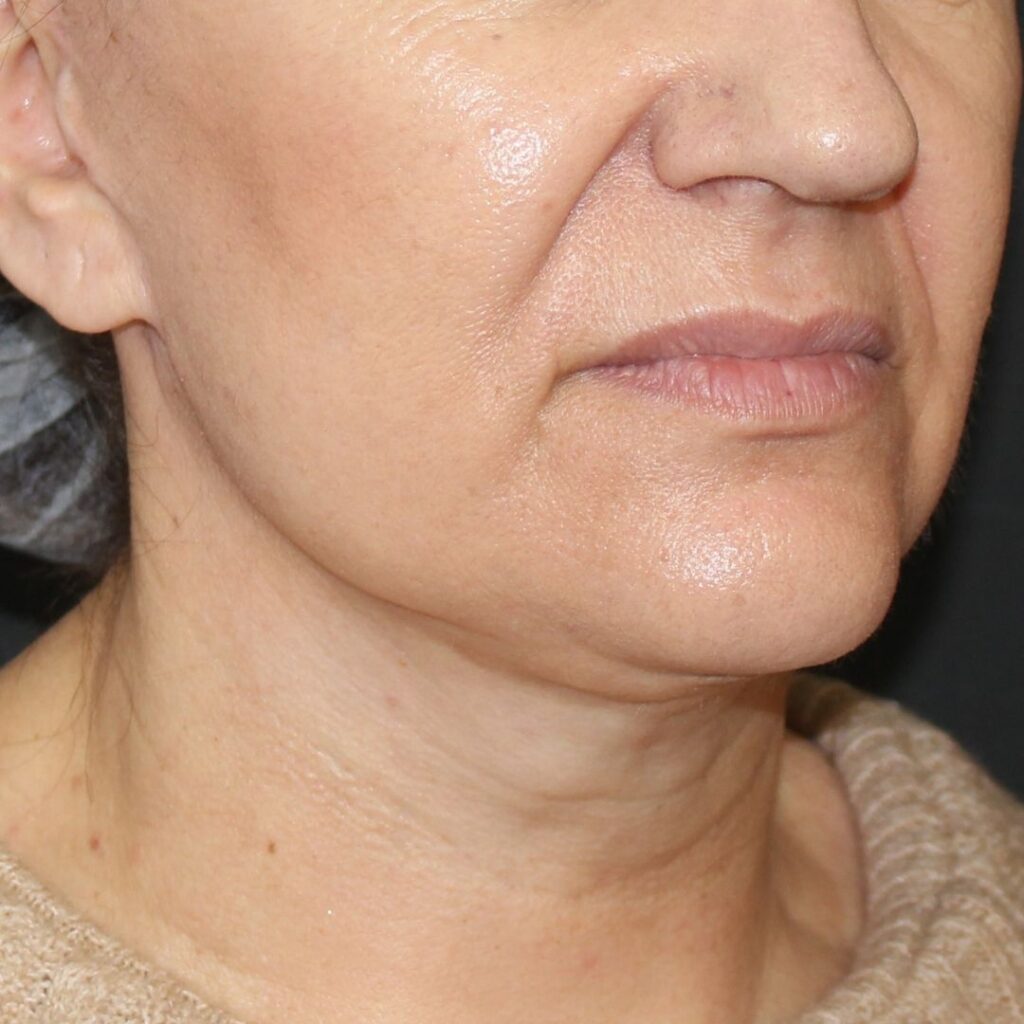 minilifting-facial-despues