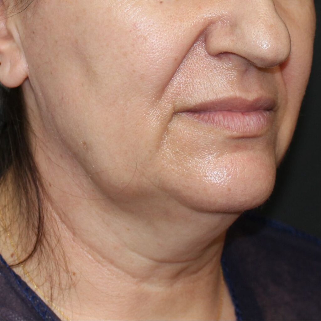 minilifting-facial-antes