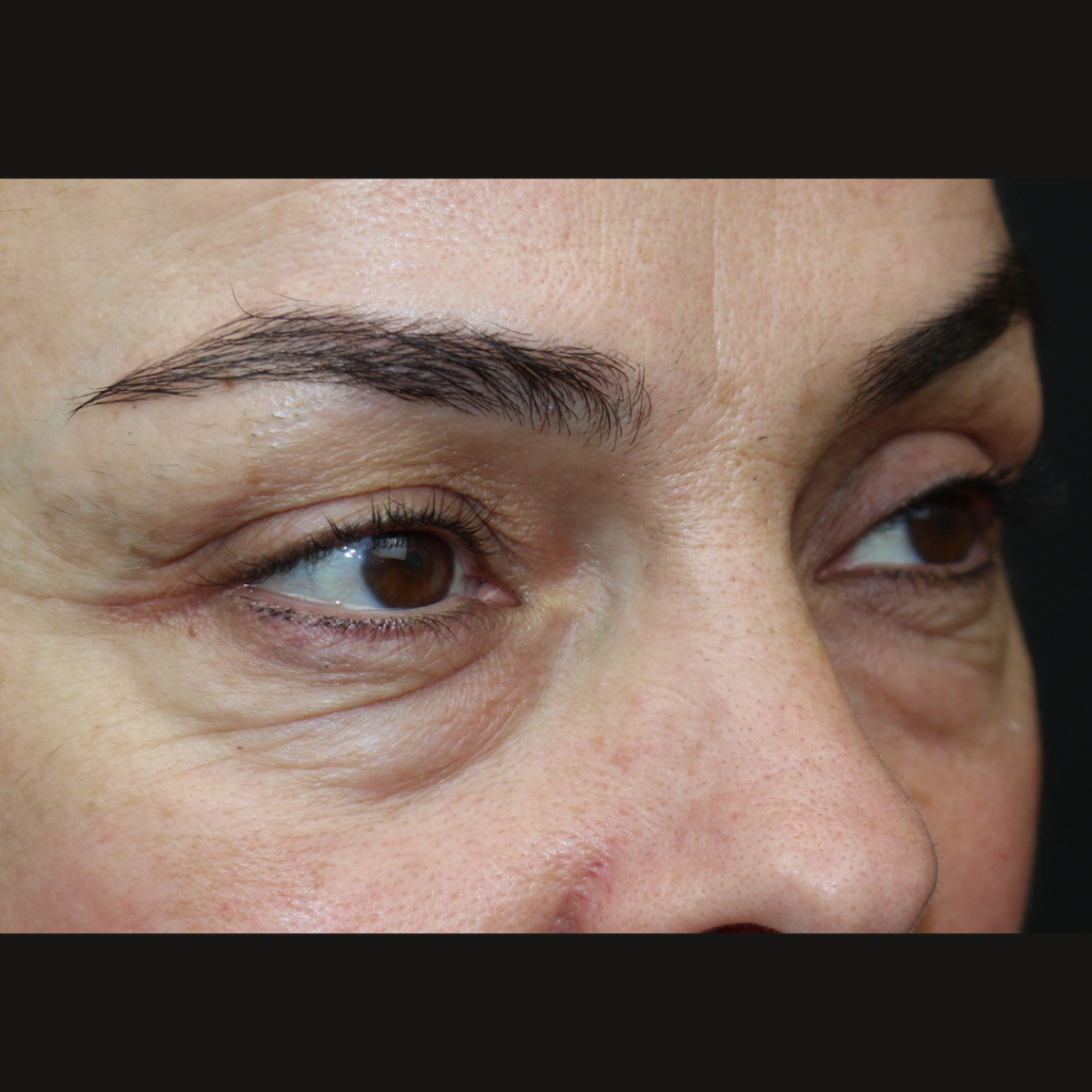 blefaroplastia-inferior-sevilla