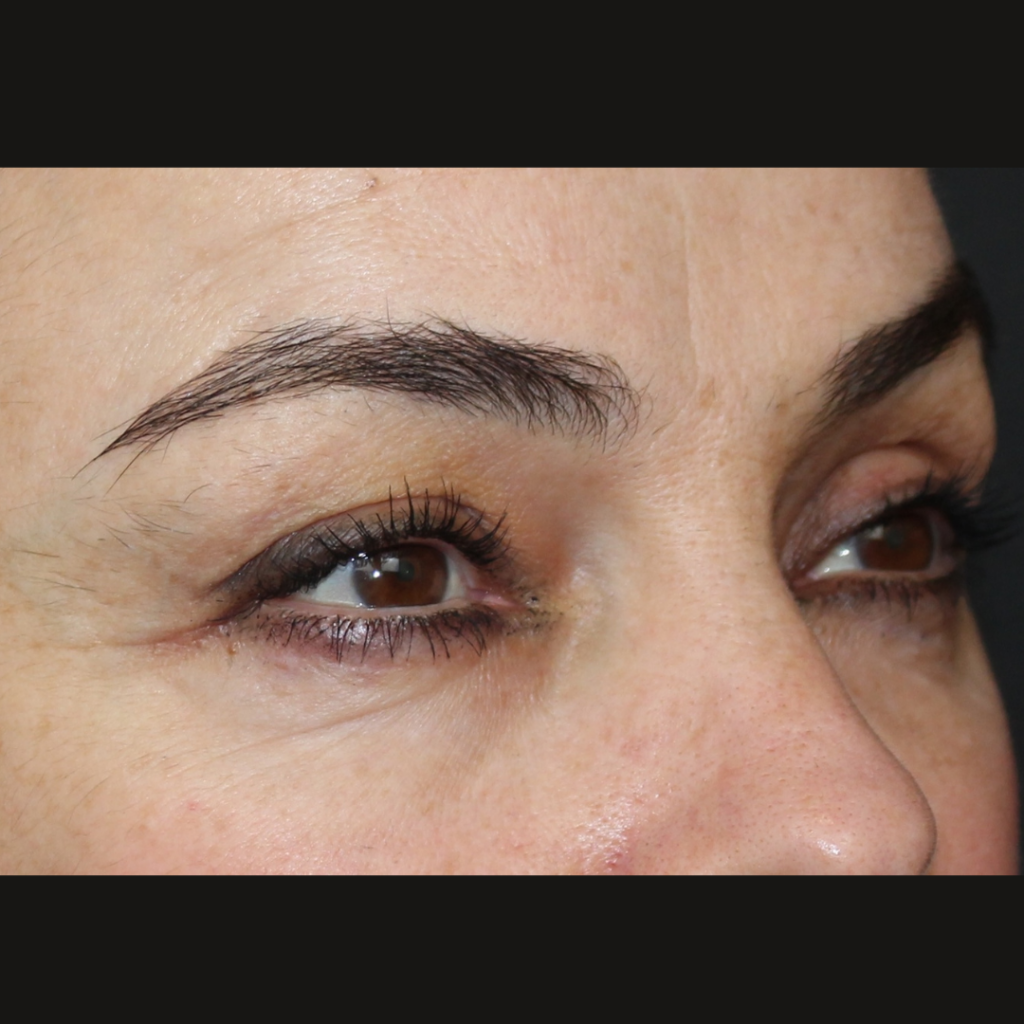 blefaroplastia-inferior-sevilla