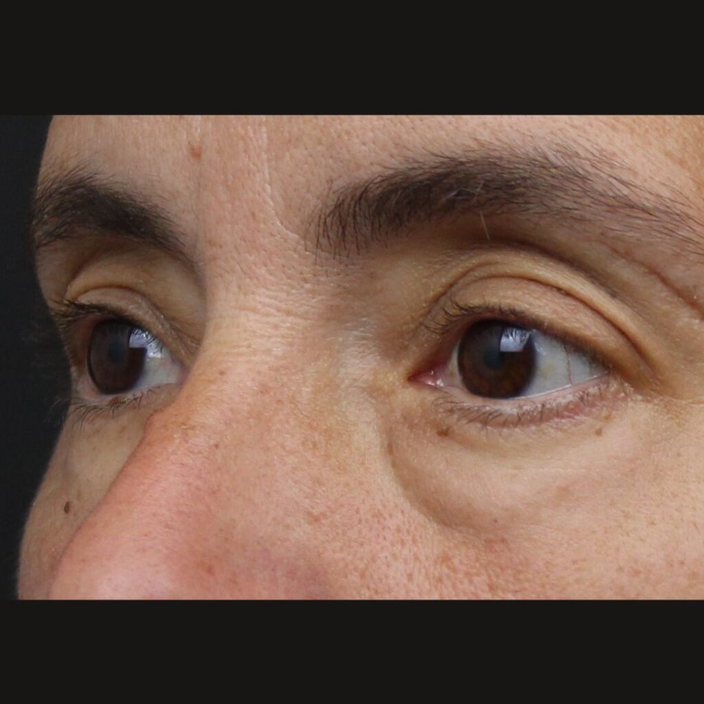 bolsas-paciente-joven