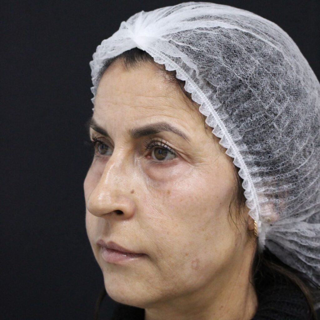 blefaroplastia-sevilla