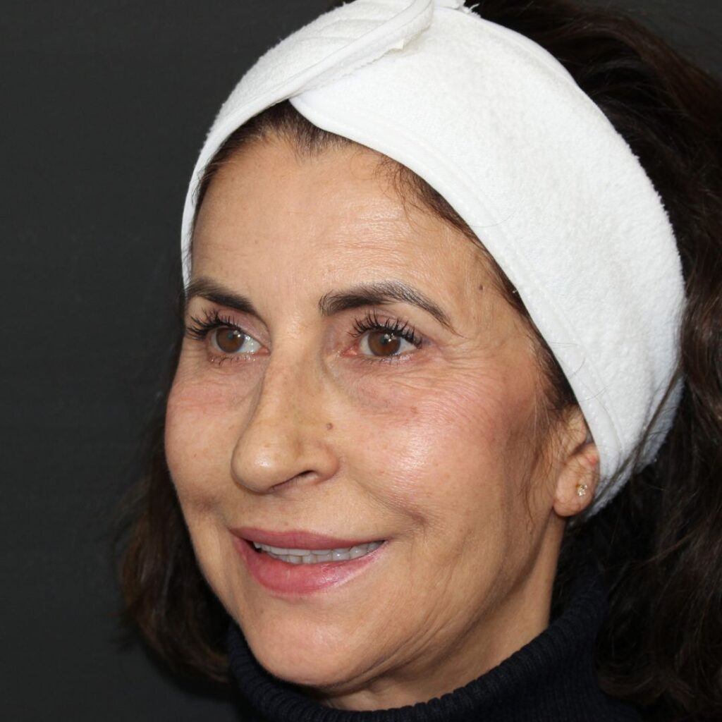 blefaroplastia-sevilla