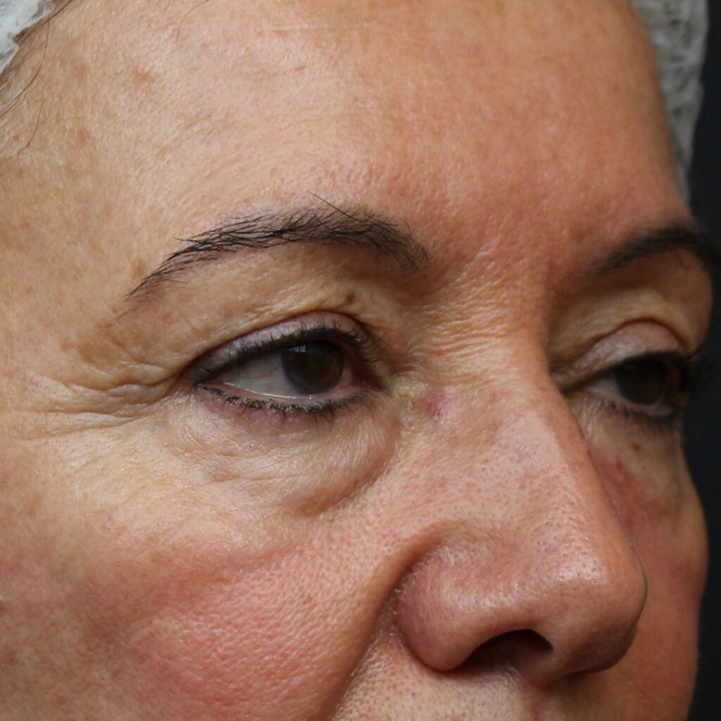 blefarolastia-superior-inferior