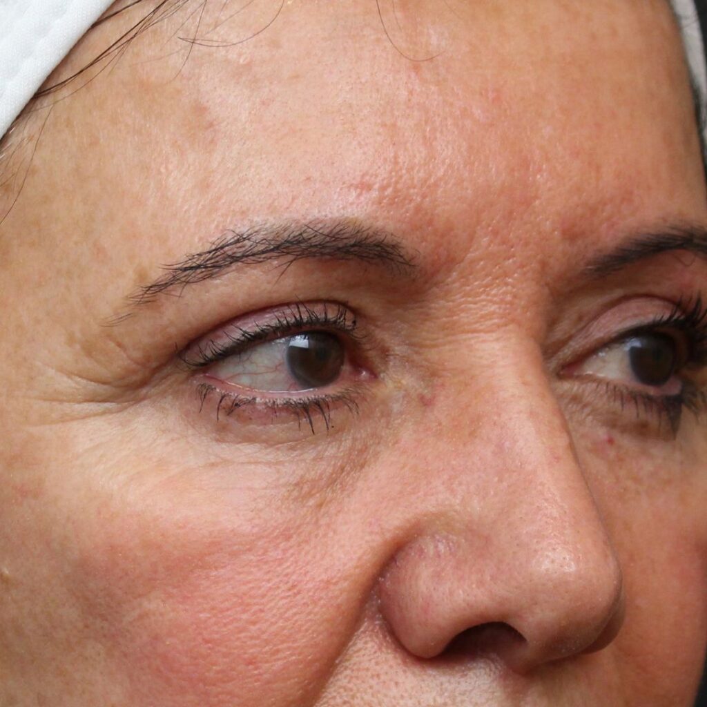 blefarolastia-superior-inferior