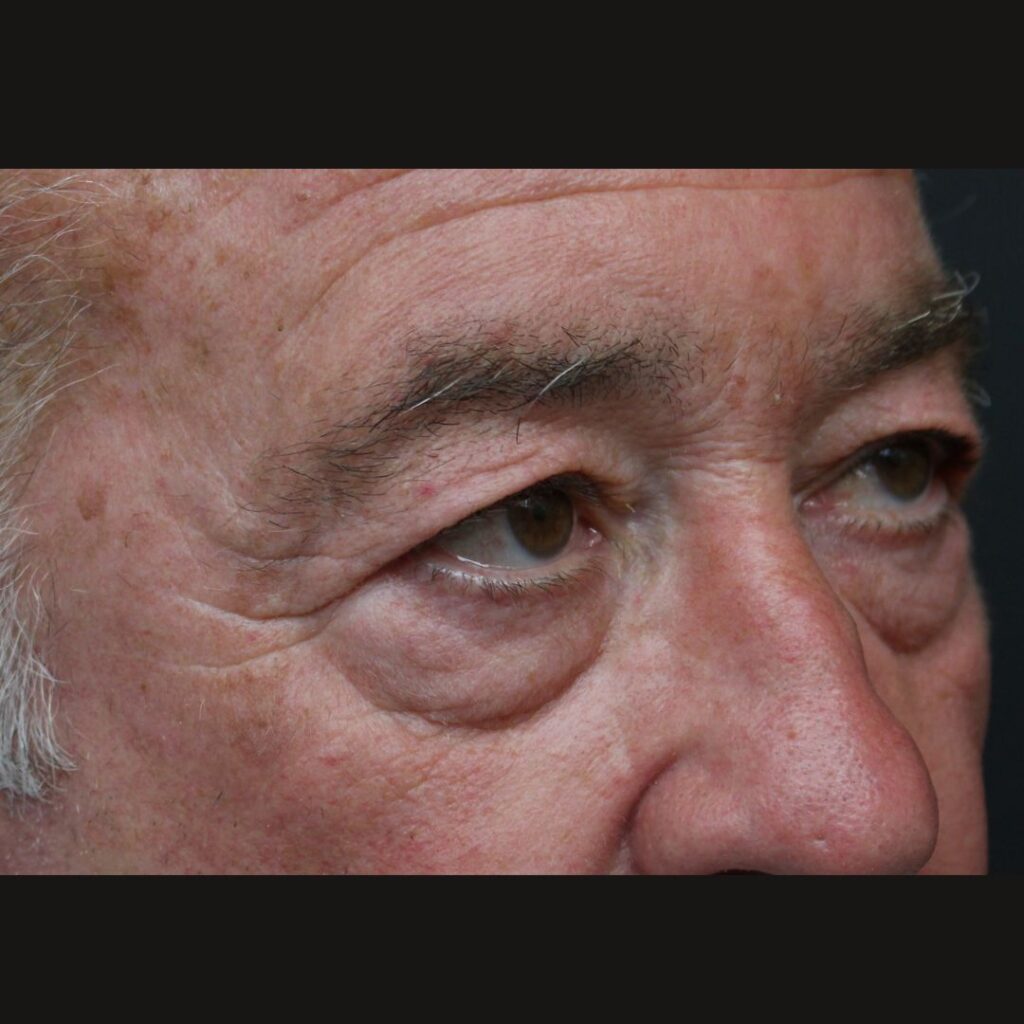 blefaroplastia-masculina