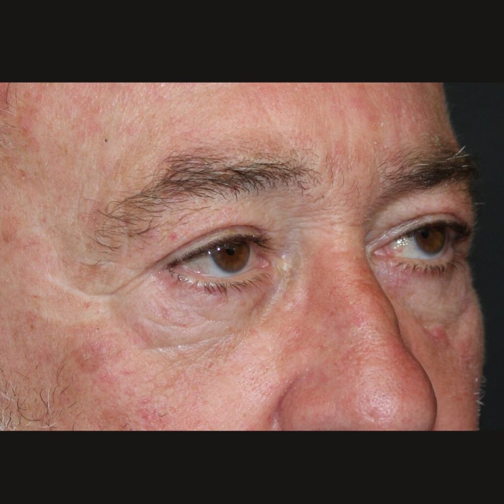 blefaroplastia-masculina