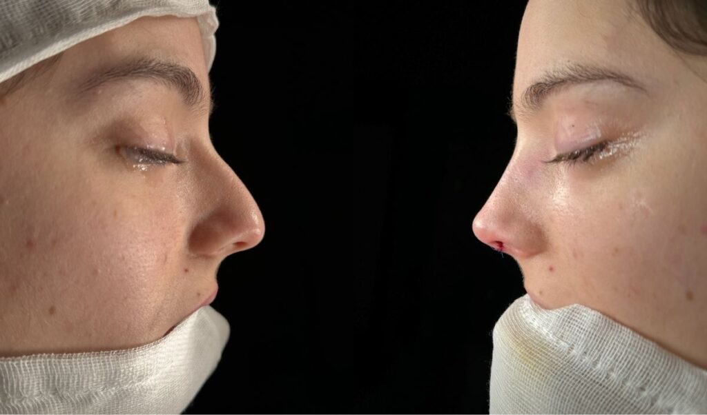 hematomas-rinoplastia