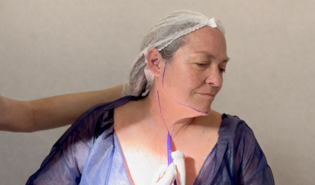 flacidez-de-la-papada