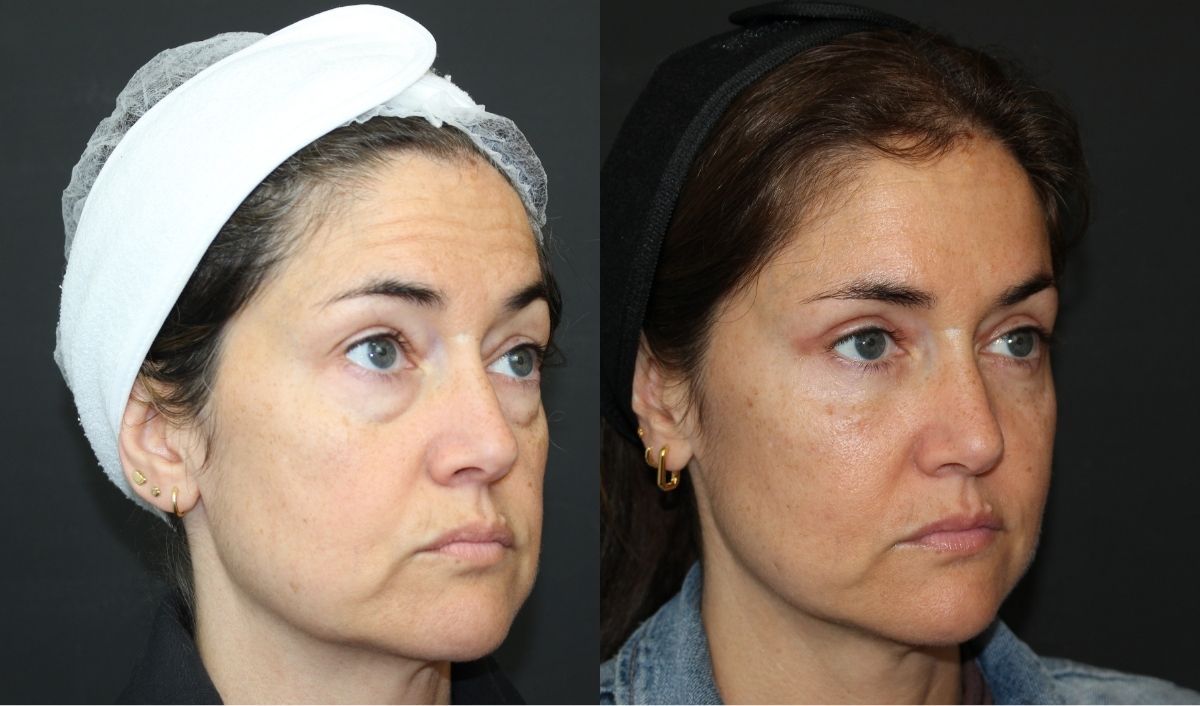 edad-blefaroplastia