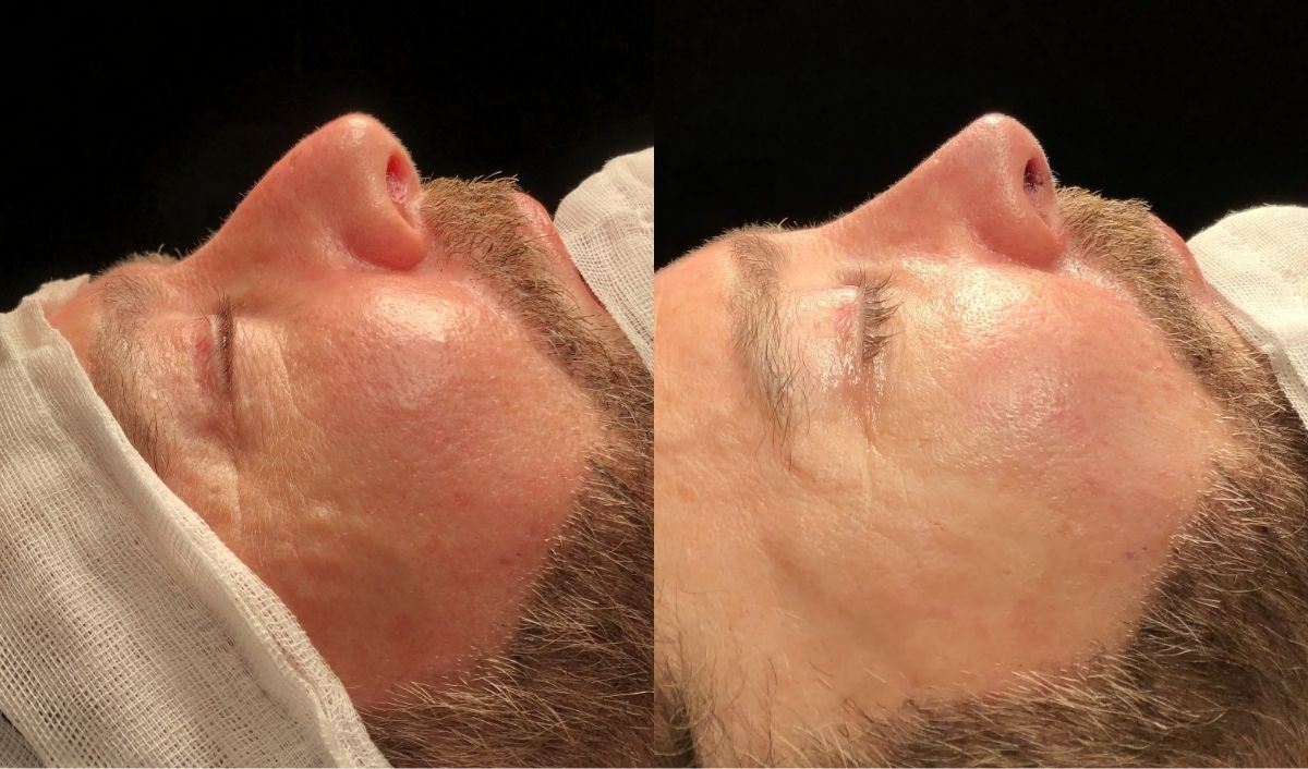 rinoplastia-masculina