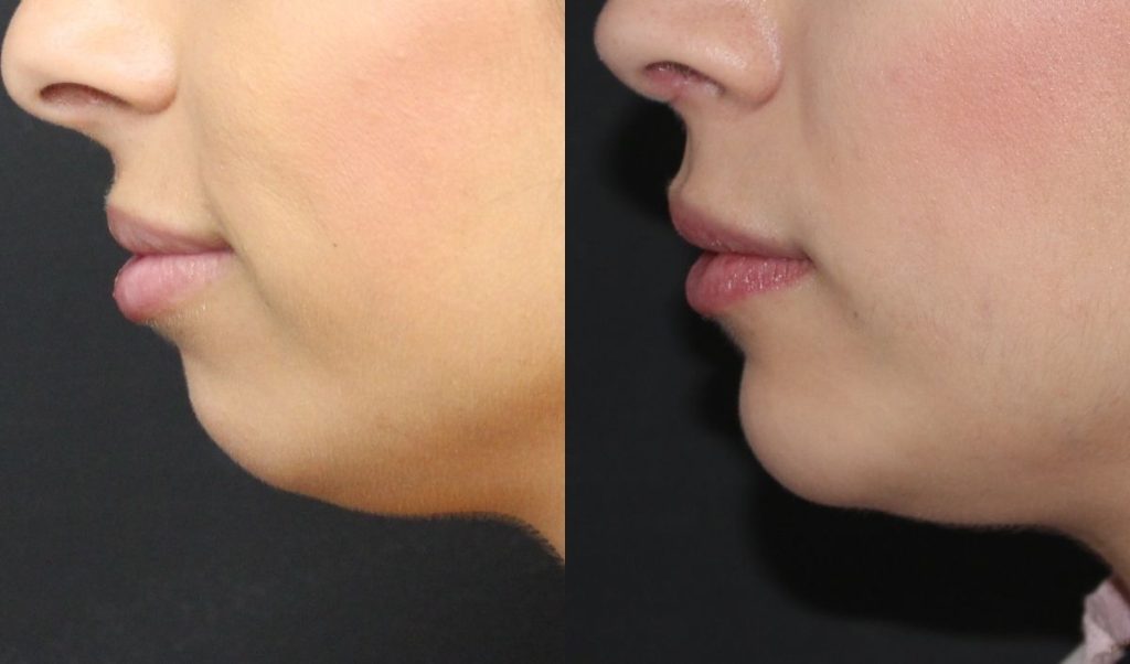 mentoplastia