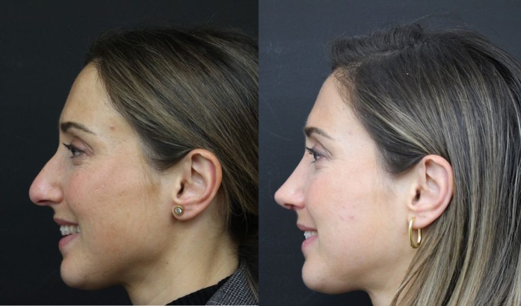 rinoplastia-en-sevilla