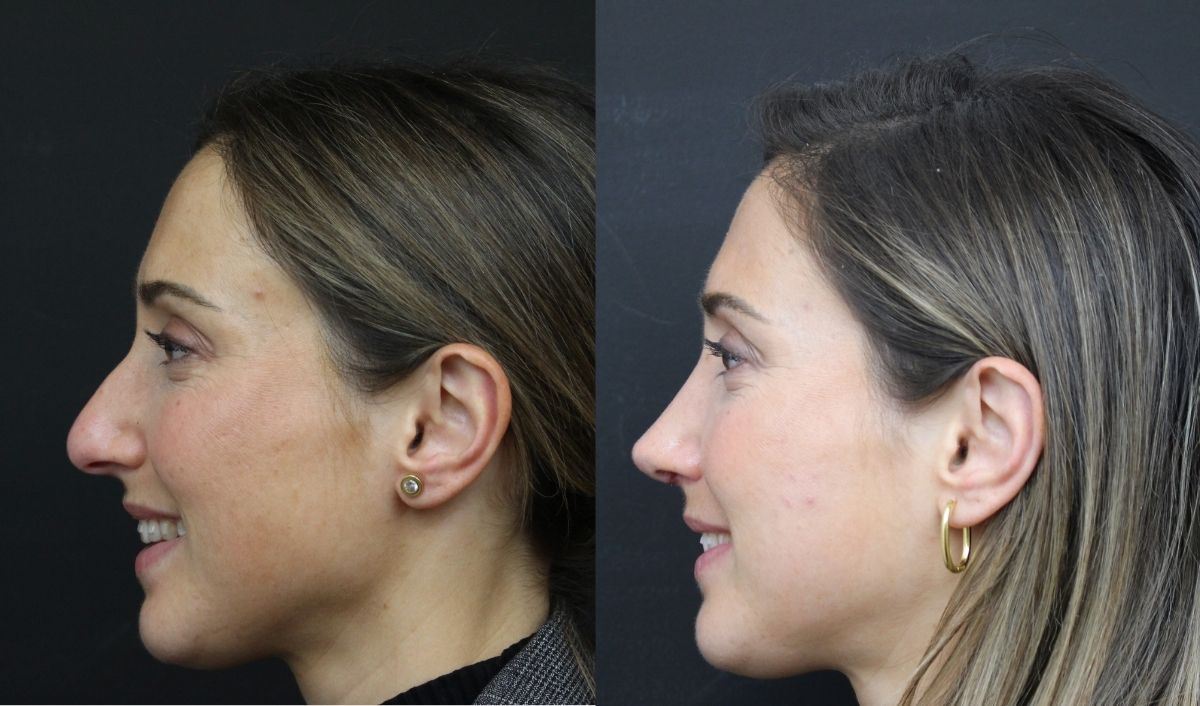 rinoplastia-en-sevilla