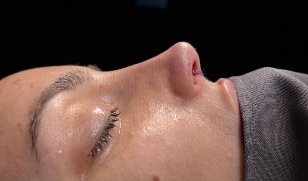 hematomas-rinoplastia