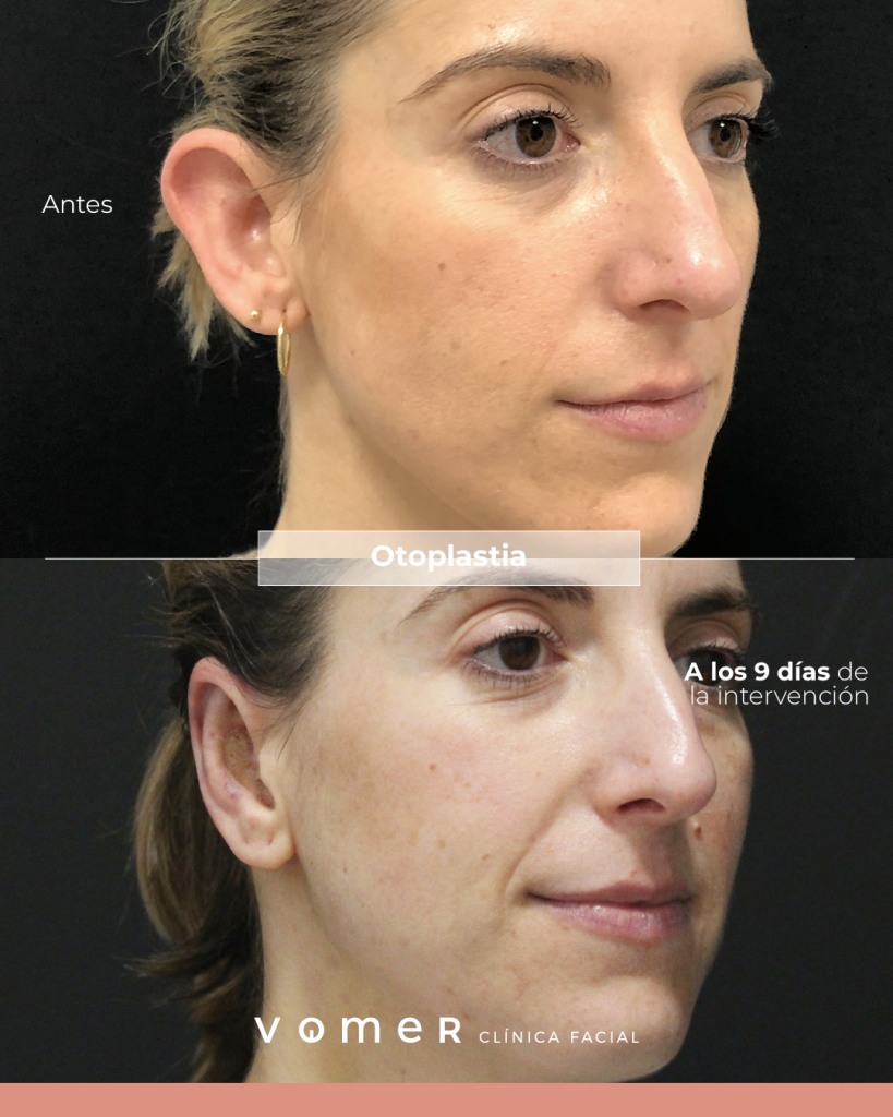 otoplastia-mujer