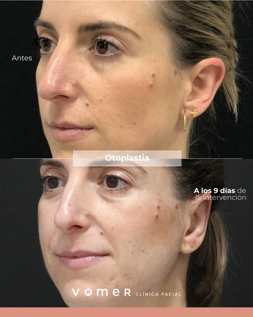 otoplastia-mujer