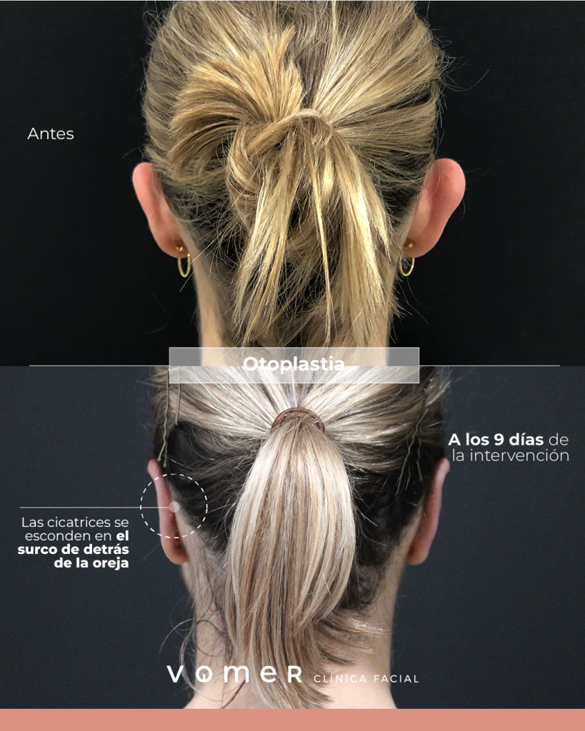 otoplastia-mujer