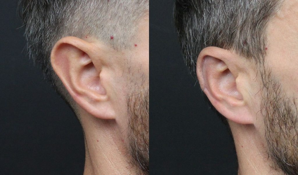 otoplastia-adultos