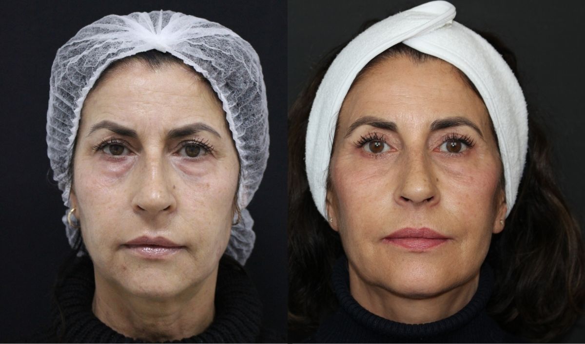 blefaroplastia-natural