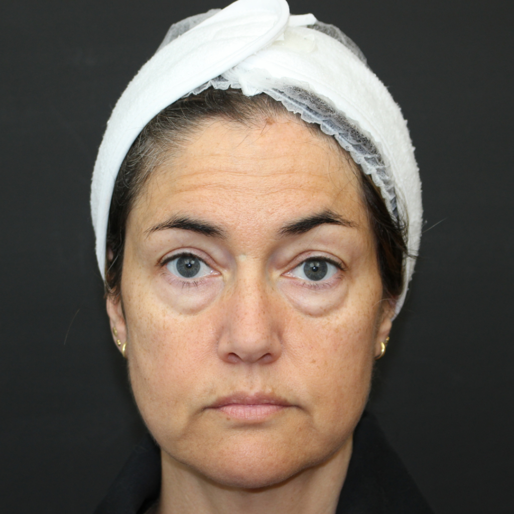 blefaroplastia transconjuntival