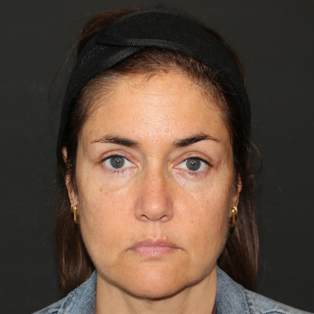 blefaroplastia transconjuntival